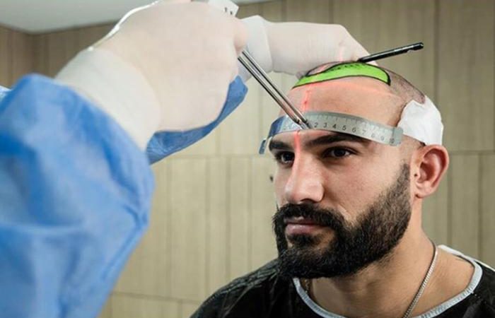 Success rates for hair transplants in Turkey